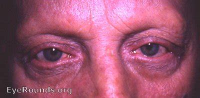 alopecia totalis with loss of eyebrows and eyelashes. EyeRounds.org: Online Ophthalmic Atlas