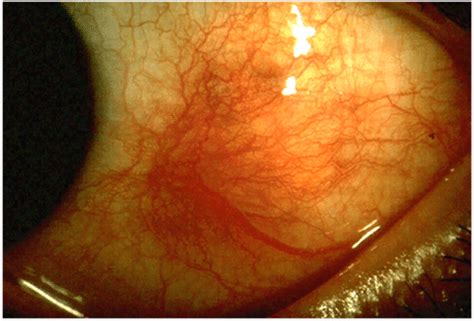 Scleritis: Causes, Picture, Symptoms, Diagnosis And Treatment