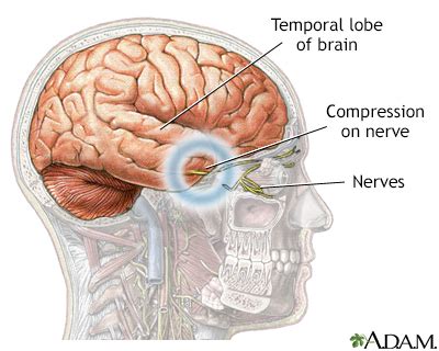 Brain herniation Information | Mount Sinai - New York