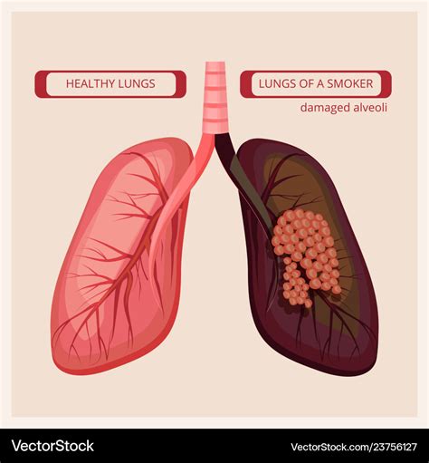 List 97+ Pictures Pictures Of Lungs After Vaping Updated