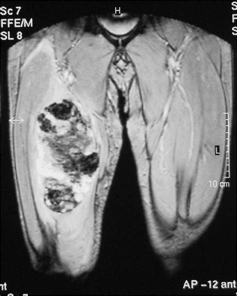 Coronal T2 weighted Gradient Echo MRI showing the same mass... | Download Scientific Diagram