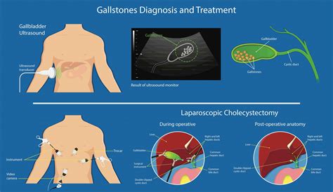 What are the Signs And Symptoms Of Gallstones? - Louise Mcgarrigle