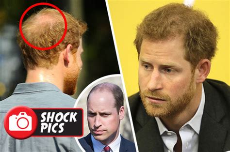 Prince Harry hair loss: Pics show royal will soon be as bald as brother Prince William - Daily Star