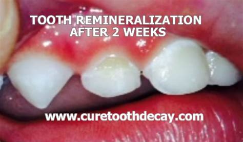 Photographic Proof of Remineralized Cavities - Healthy Home Economist