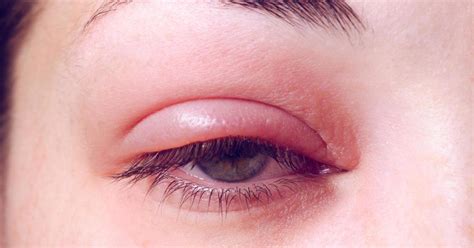 What Could a Swollen Eyelid Mean: 10 Possible Causes