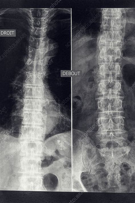 Osteoarthritis of the lumber spine, X-ray - Stock Image - C036/8214 - Science Photo Library