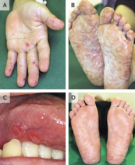 Hand, Foot, and Mouth Disease in an Adult | NEJM