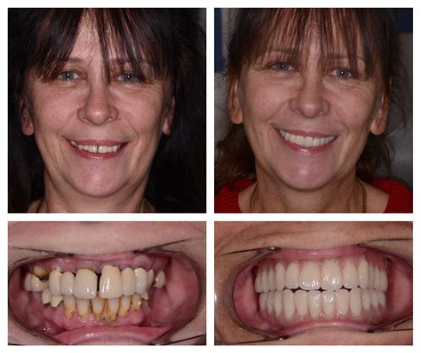 Zygomatic Dental Implants Surrey - Mulberry Dental