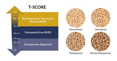 Osteopenia In The Elderly: Essential Things To Know | Ninkatec