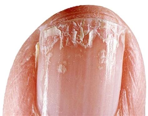 Split Fingernails (Onychoschizia): Symptoms, Causes & Remedies