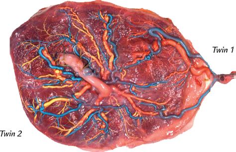 [PDF] Velamentous cord insertion and unequal placental territories in monochorionic twins with ...