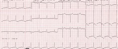 Left ventricular hypertrophy (LVH) with strain pattern