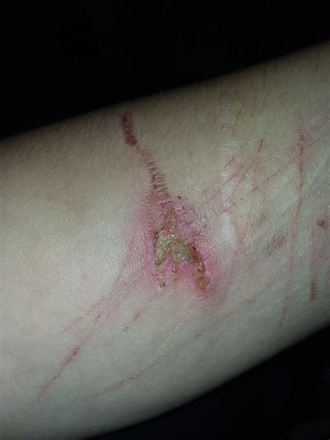 Does this 5 day old burn look Infected? : r/medical