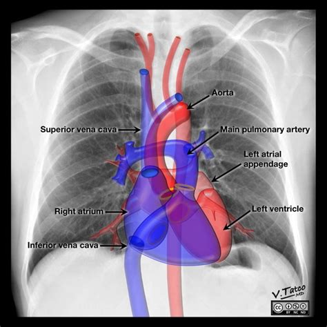 Contornos normales del cardiomediastino en la radiografía de tórax