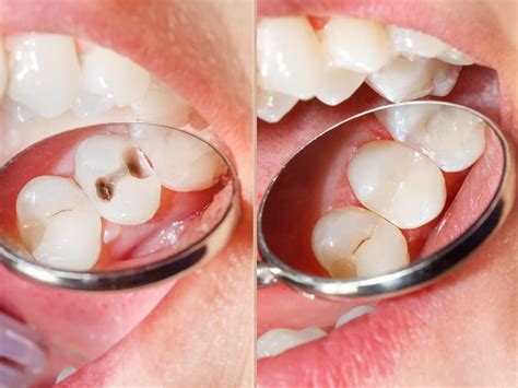 What Is A Composite Filling? - Magnolia Dental