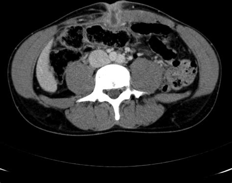 Infected urachal cyst in an adult | Emergency Medicine Journal