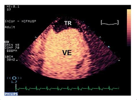 Contrast echocardiography in apical four chamber view demonstrating ...