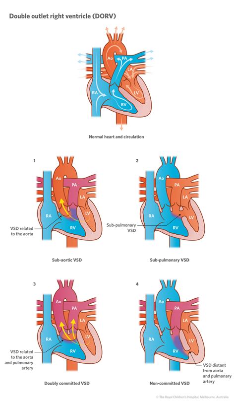 Hello and welcome to my blogspot!: 23. Specific Lesions: Double outlet right ventricle (DORV)