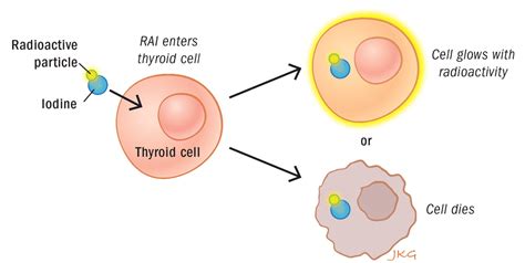 Radioactive Iodine (RAI) ‣ THANC Guide