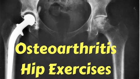 Osteoarthritis Hip Exercises | Osteoarthritis hip, Rheumatoid arthritis ...