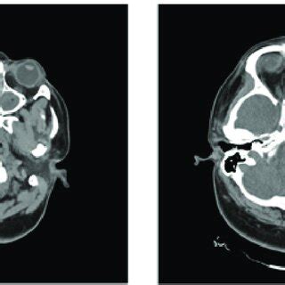 (PDF) Case Report-Subdural Empyema as a Life-threatening Complication ...