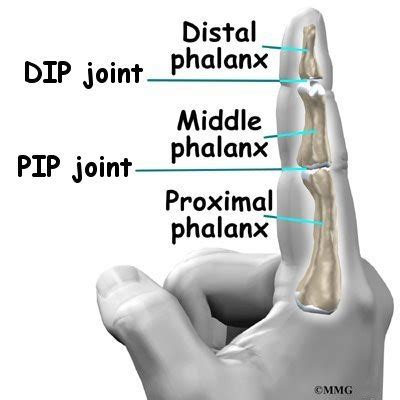 Artificial Joint Replacement of the Finger | eOrthopod.com