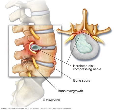 Back surgery: When is it a good idea? - Mayo Clinic