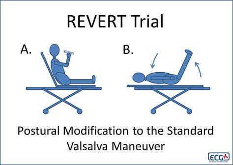 Modified Valsalva Maneuver for SVT - The Emergency Medical Minute