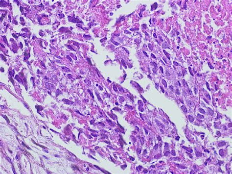 Large acidophilic cytoplasm of tumor cells of old lung biopsy (H&E ...