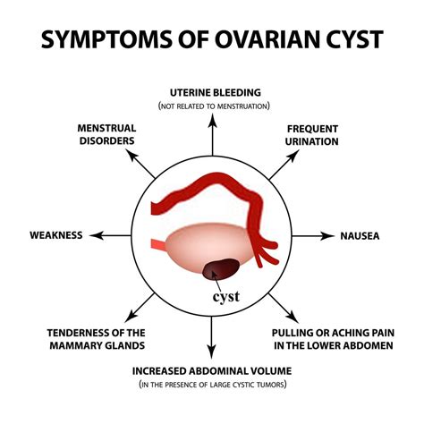 Right Ovarian Hemorrhagic Cyst In Hindi - blogrotu1