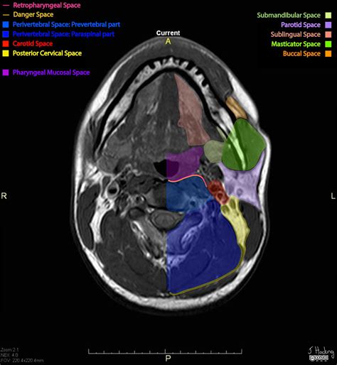 Ct Scan Neck Anatomy