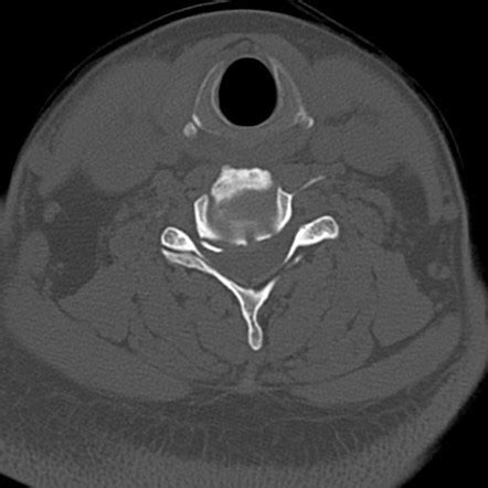 Intraosseous pneumatocyst of the first rib. | Radiology Case ...