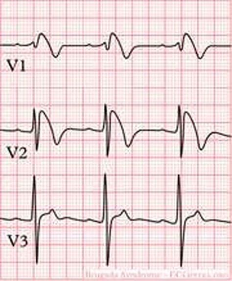 Brugada ECG: high take-off and downsloping ST segment elevation in V1 – V3. | Download ...