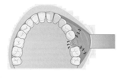 WizDent: Buccal advancement flap