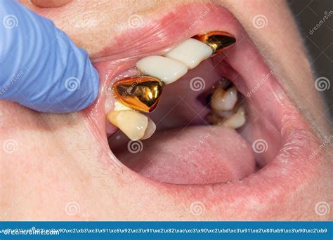 Patient with Bad Metal Dental Crowns Close-up. the Concept of Treatment ...