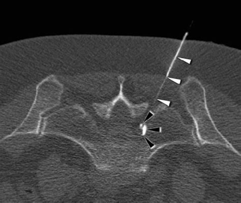 CT-guided S1 nerve root injection. The black arrowheads indicate the ...