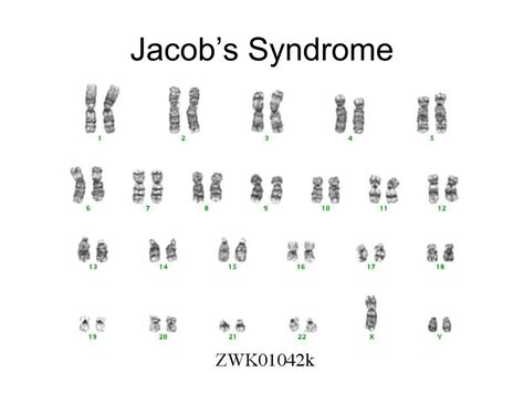 Jacobsen Syndrome Karyotype