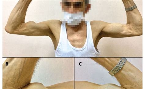 Popeye Deformity Biceps Tendon Rupture Shoulder Injury Exercises ...