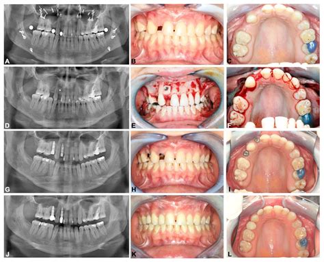 Hypodontia Before And After