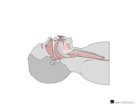 Oropharyngeal Airway Diagram