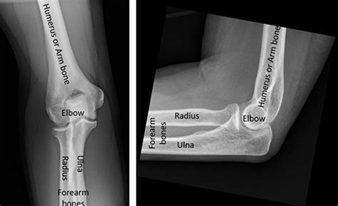 Elbow Dislocation | Orthopaedic Trauma Association (OTA)