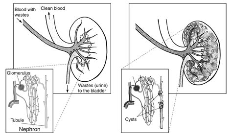 What Is Medullary Sponge Kidney? - StoryMD