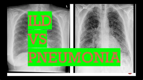 Interstitial Pneumonia X Ray