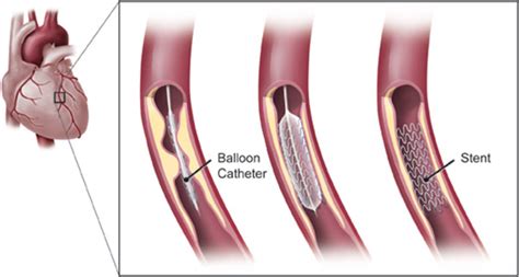 Coronary Angioplasty and Stenting | Dr. Lim Ing Haan Cardiology Clinic