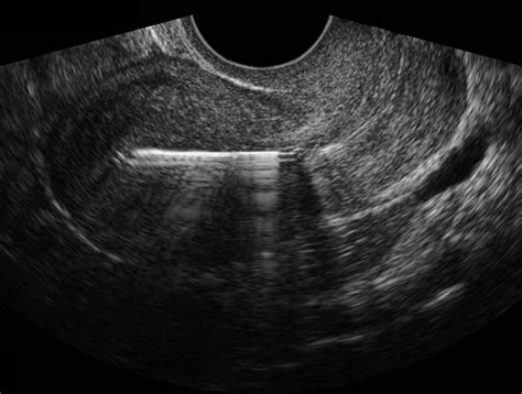 Paragard Iud Ultrasound