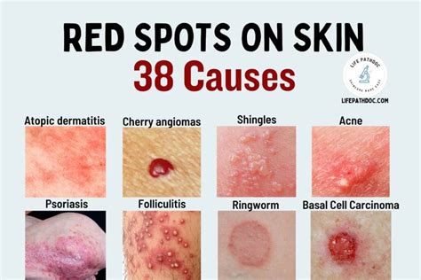 7 Reasons Your Skin Has Red Spots And Bumps Red Skin - vrogue.co