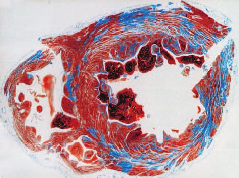 Histologic features of the anterior wall of the left ventricle in the ...