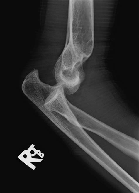 Elbow dislocation - Radiology at St. Vincent's University Hospital