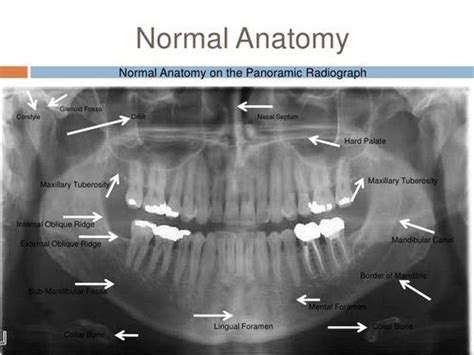 Normal Anatomy on the Panoramic Radiograph Dentaltown - Anatomical ...