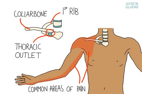 Thoracic Outlet Syndrome - Gemini Osteopathy